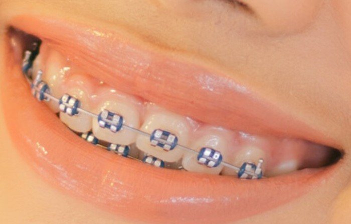 What Is The Cost Of Braces In Nigeria In 2024?